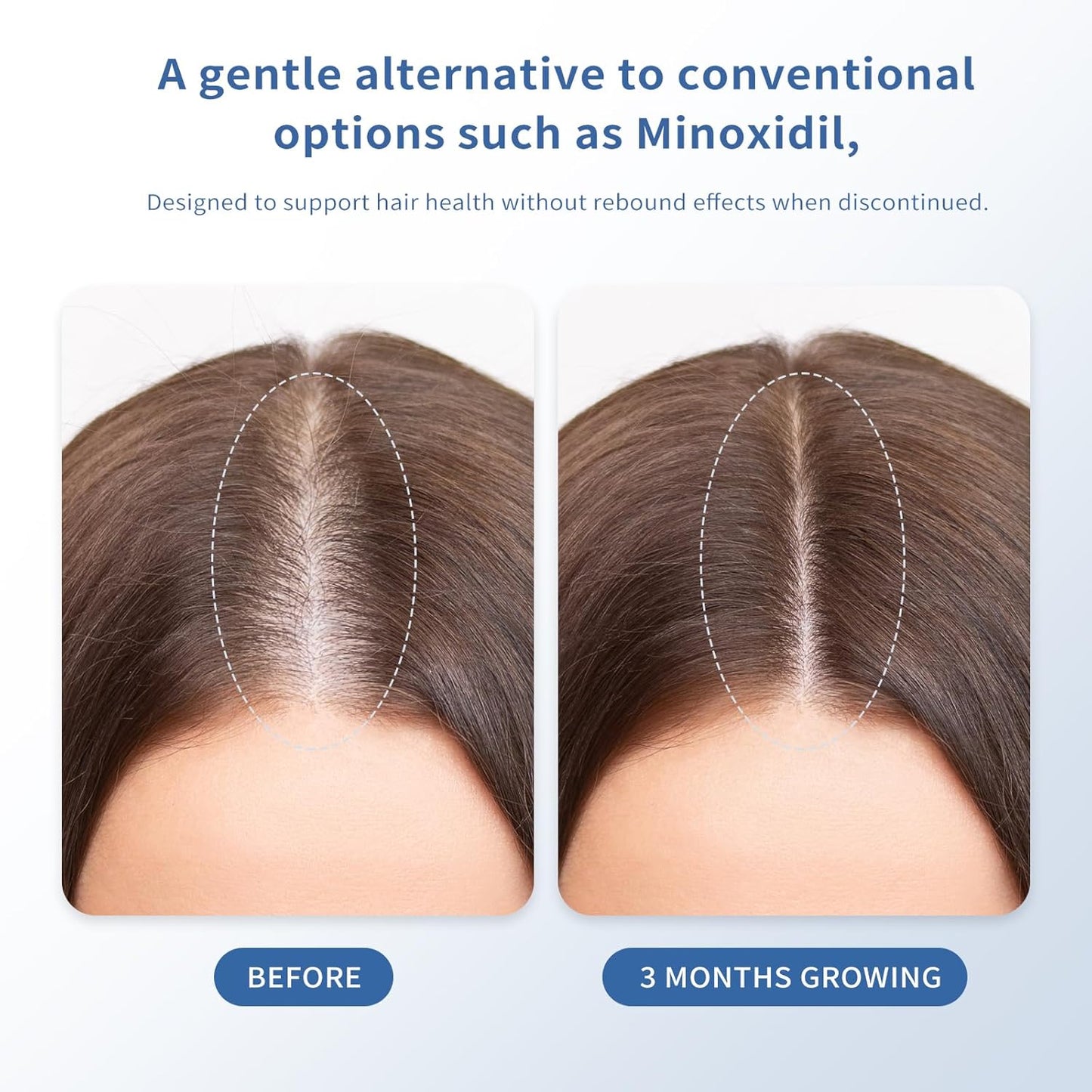 Hair Growth Serum Roll-On 30ml | Patented Blend with 3% Rosemary, 3% Redensyl, 2% AnaGain, Biotin & Niacinamide | No-Rinse, Fast-Absorbing | For Thinning Hair & All Hair Types (1.01 Fl Oz (Pack of 1)) - Glowelle