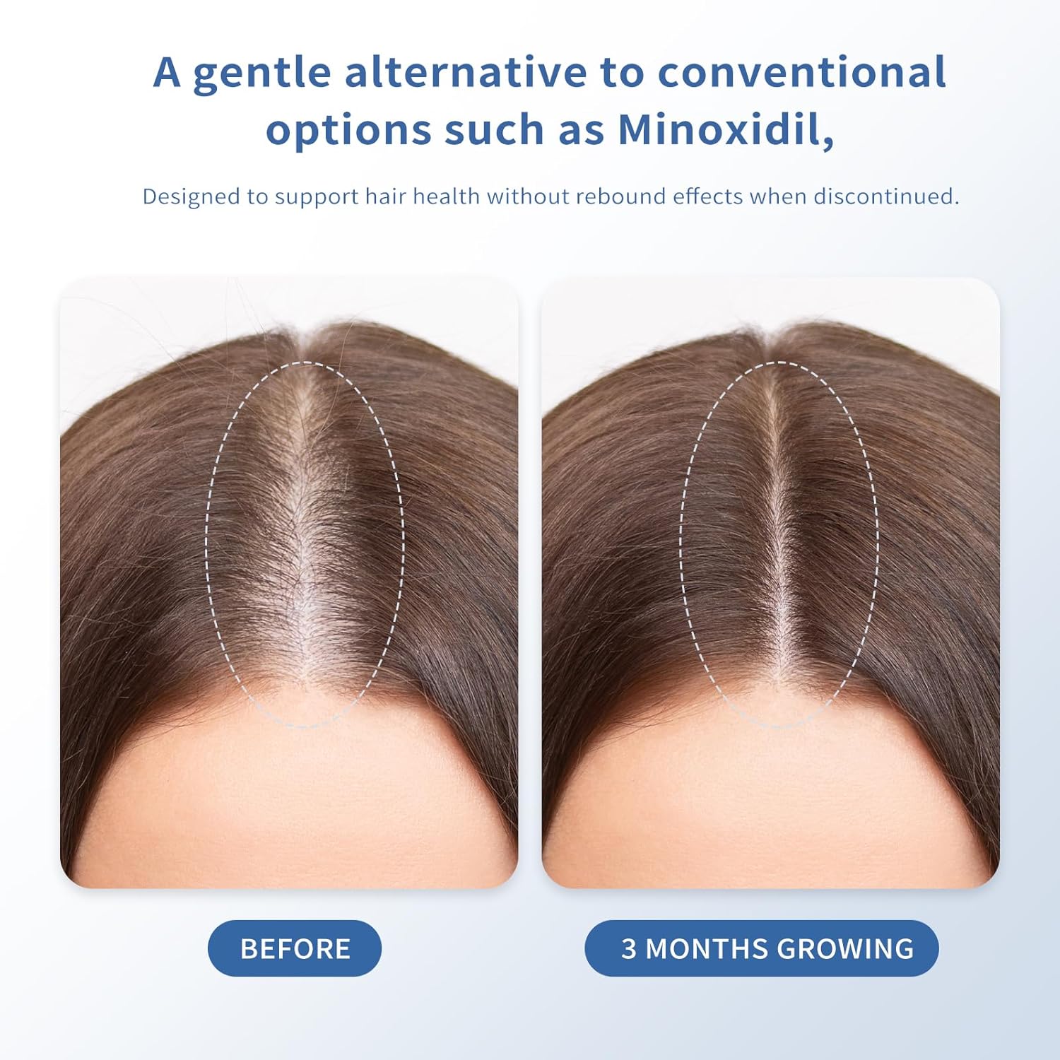 Hair Growth Serum Roll-On 30ml | Patented Blend with 3% Rosemary, 3% Redensyl, 2% AnaGain, Biotin & Niacinamide | No-Rinse, Fast-Absorbing | For Thinning Hair & All Hair Types (1.01 Fl Oz (Pack of 1)) - Glowelle