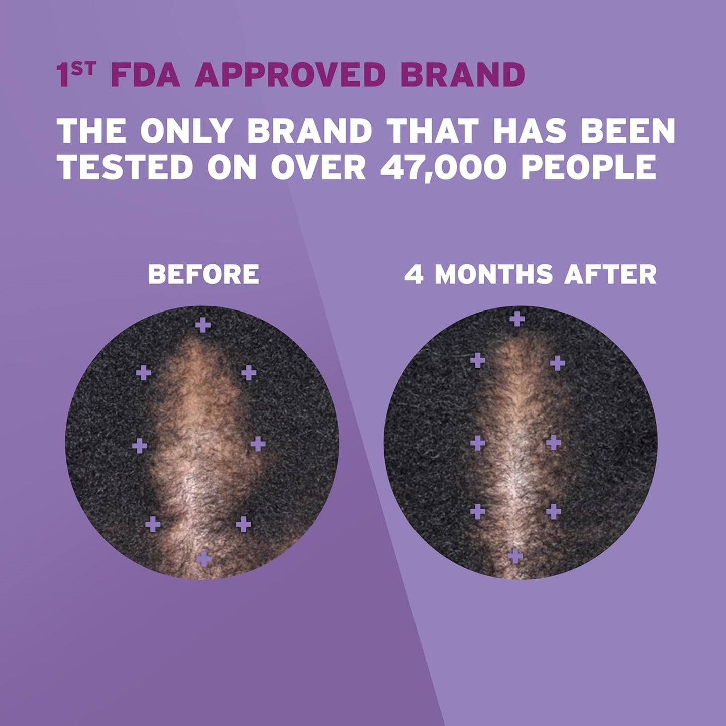 Rogaine 5% Minoxidil Foam, Topical Once-A-Day Hair Loss Treatment for Women to Regrow Fuller, Thicker Hair, Unscented, 2-Month Supply, 2.11 oz - Glowelle