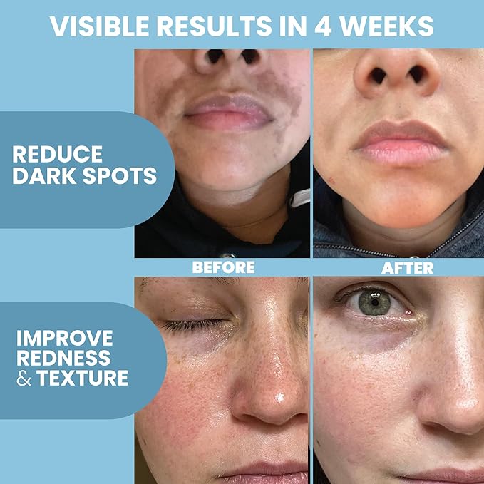 Azelaic Acid 10% Facial Serum – 2 oz (2 Pack) – With Niacinamide and Hyaluronic Acid – Lightweight Face Serum