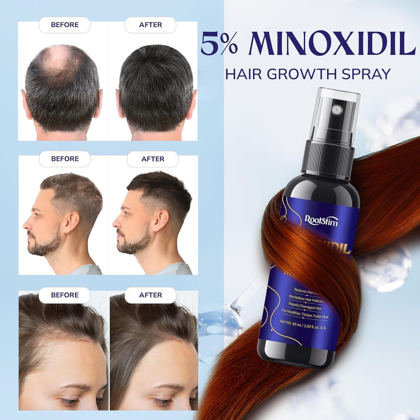 5% Minoxidil Hair Growth for Men and Women: 2-Pack Extra Strength Minoxidil Hair Loss Treatment Serum with Rosemary for Faster Stronger Thicker Hair Growth 4 FL OZ