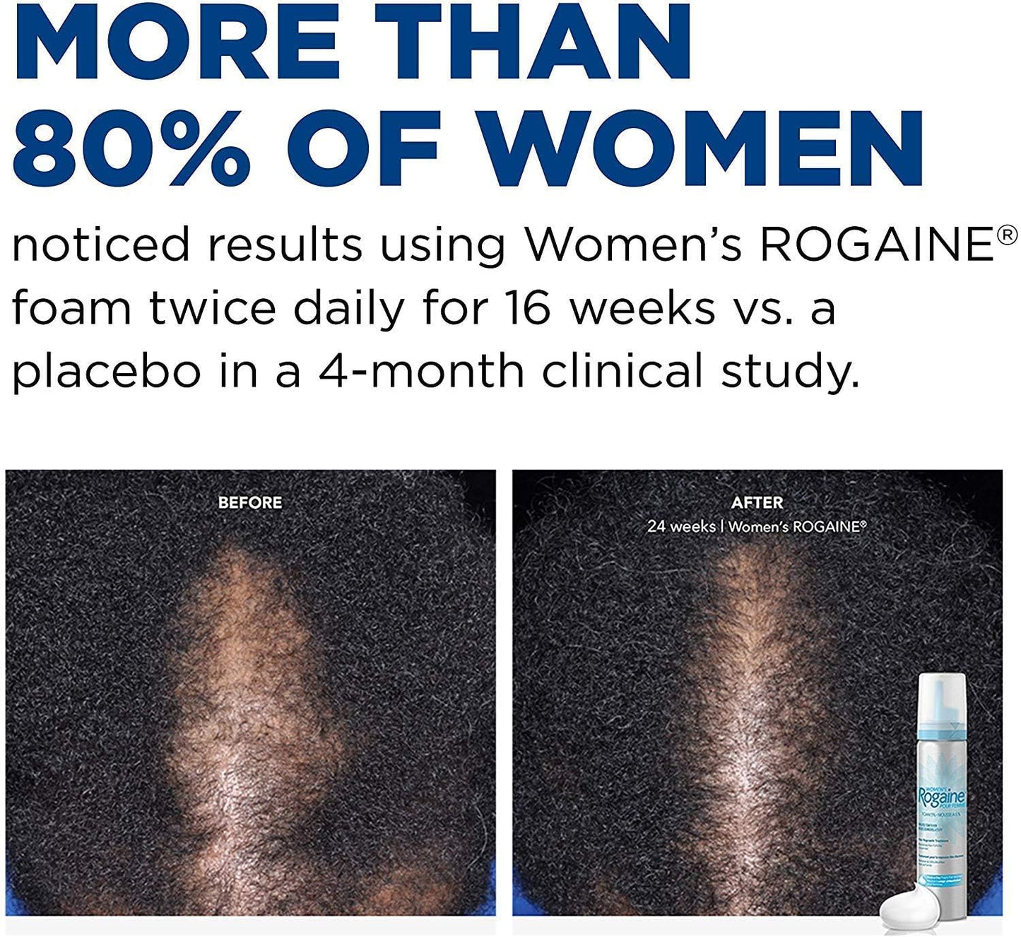 Rogaine 5% Minoxidil Foam, Topical Once-A-Day Hair Loss Treatment for Women to Regrow Fuller, Thicker Hair, Unscented, 2-Month Supply, 2.11 oz - Glowelle
